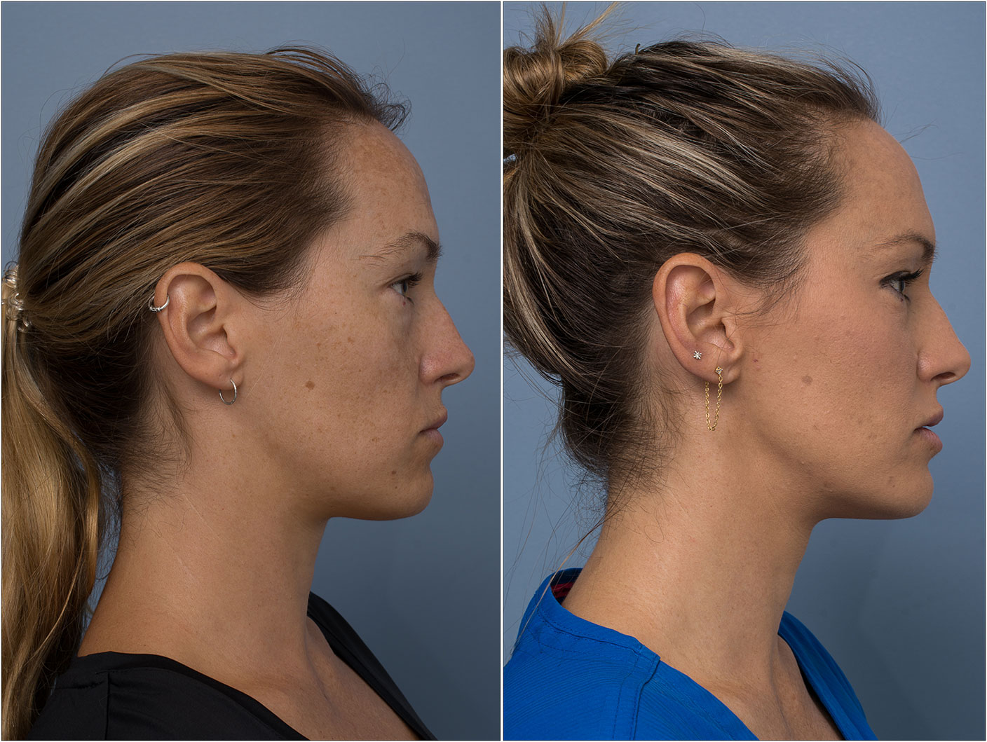 chin fillers before and after